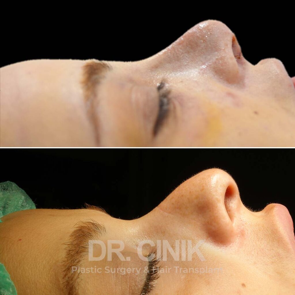 rhinoplasty result at Dr. Cinik clinic in Istanbul