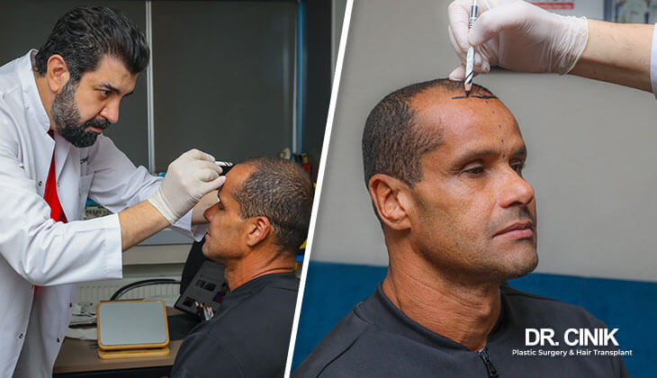 dr cinik best hair transplant surgeon