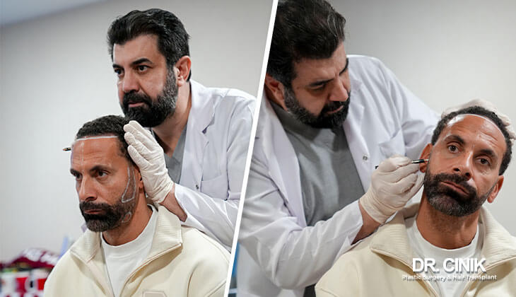 The Top 5 Benefits of Choosing Turkey for an FUE Hair Transplant
