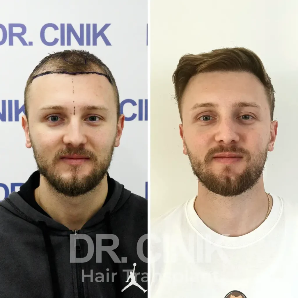 FUE hair transplant before and after result at dr cinik clinic 1