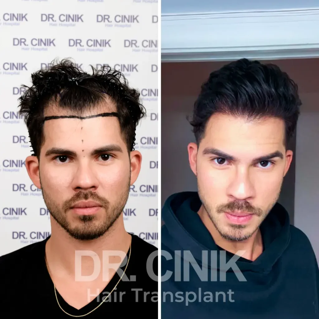 FUE hair transplant before and after result at dr cinik clinic