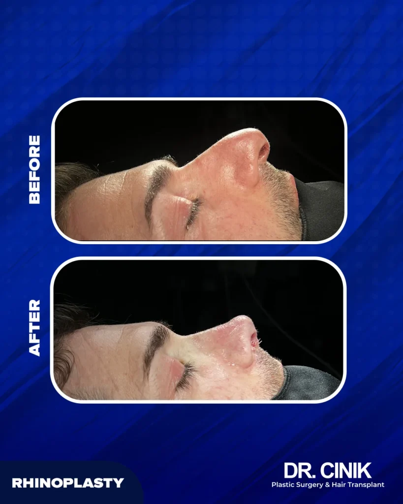 Men nose job before after at DR CINIK hospital