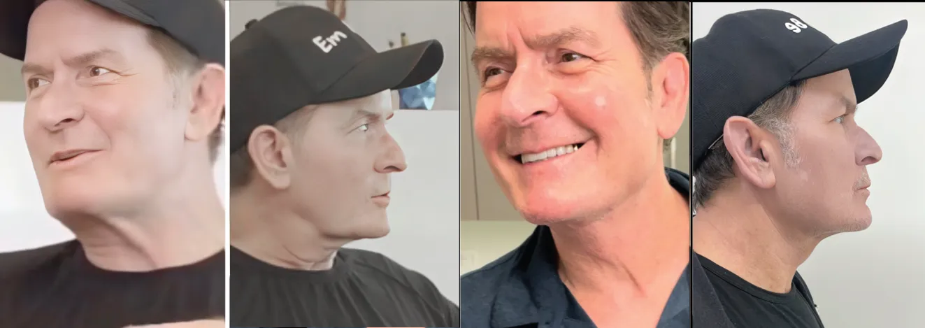 Charlie Sheen's Neck and Face Rejuvenation