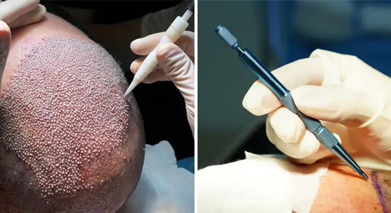 Difference between FUE and DHI