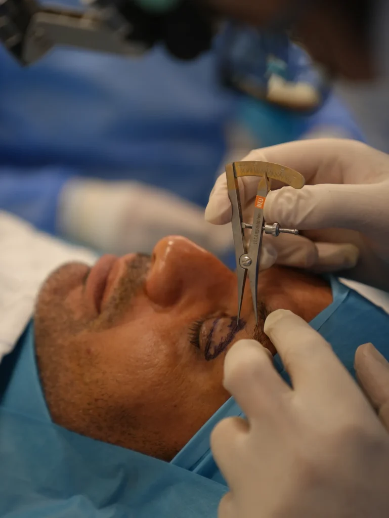Eye lid surgery for Men