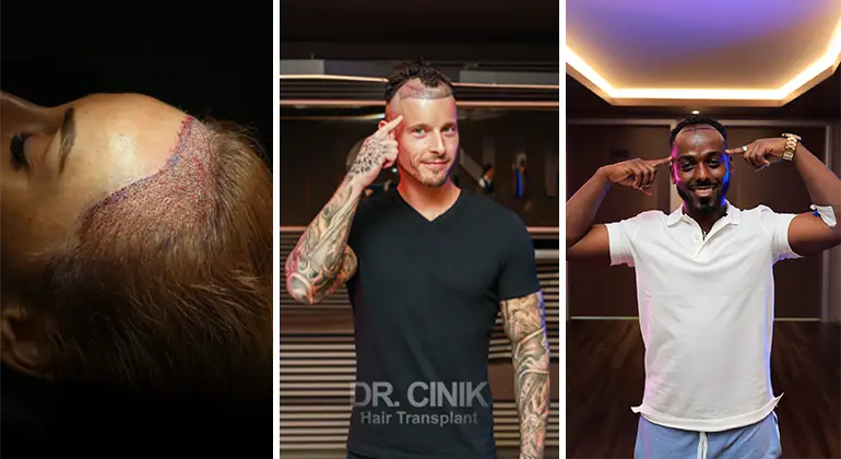 Happy patients at dr cinik hairtransplant hospital after finishing their procedure