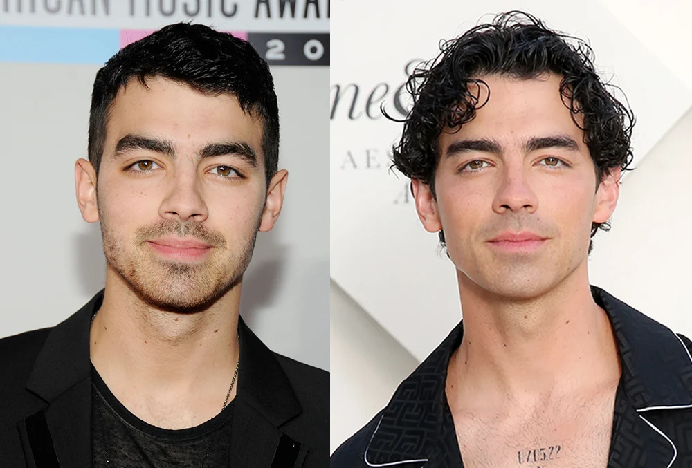 Joe Jonas filler injectables use