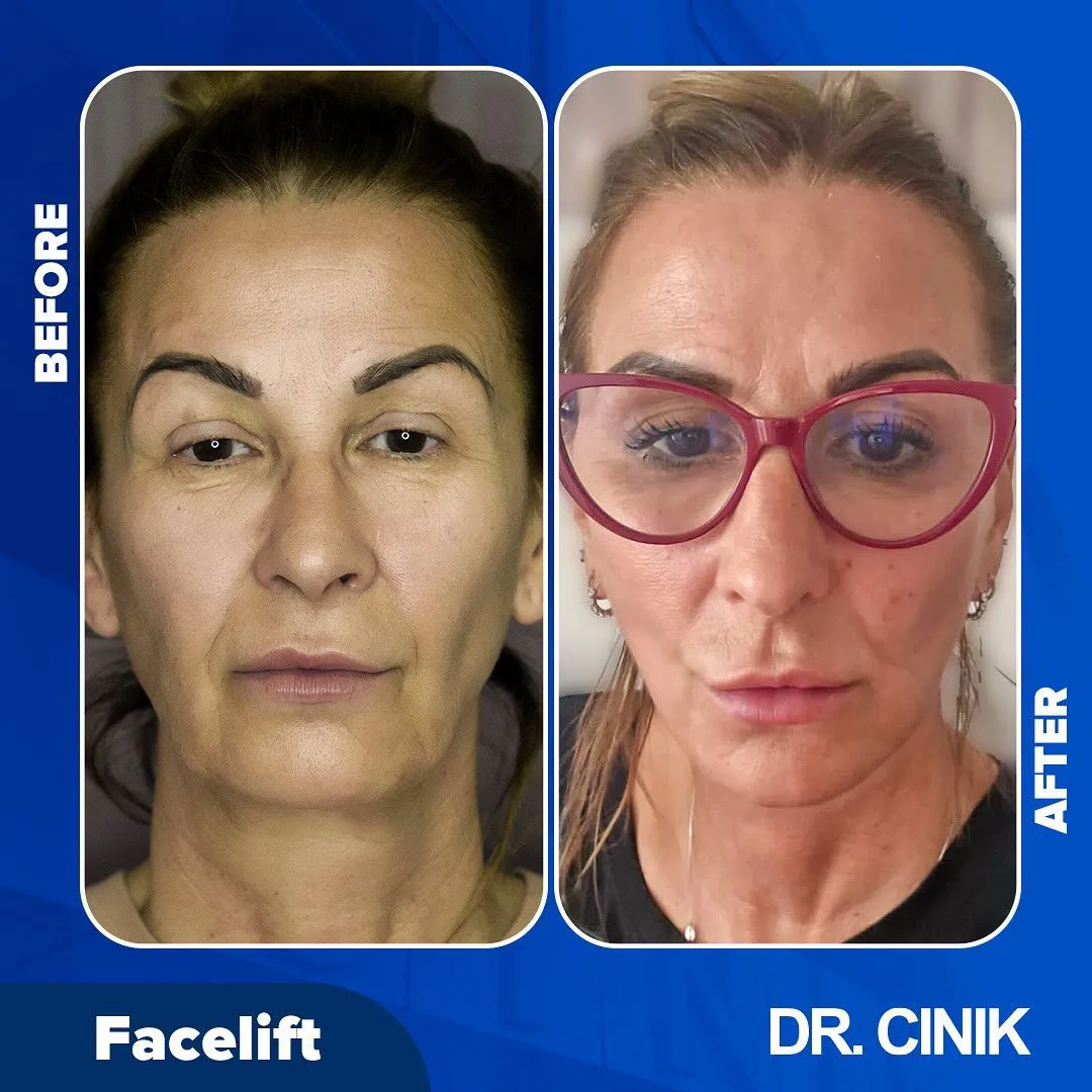 Facelift procedure before/after results