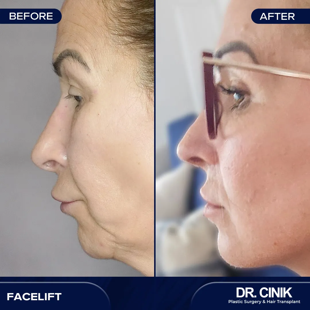 Aged woman facelift surgery before and after