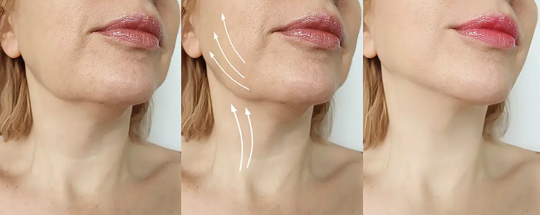 Facelift amazing results