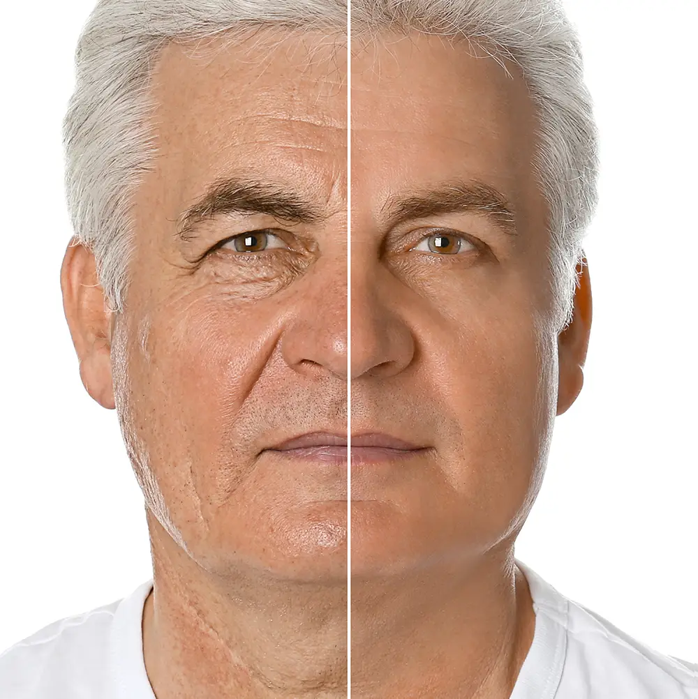 facelift for men