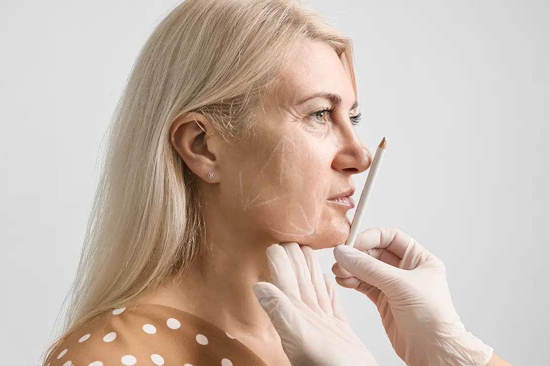 50+ woman preparing for a facelift surgery