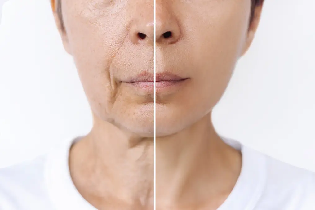 The advantages of a facelift procedure