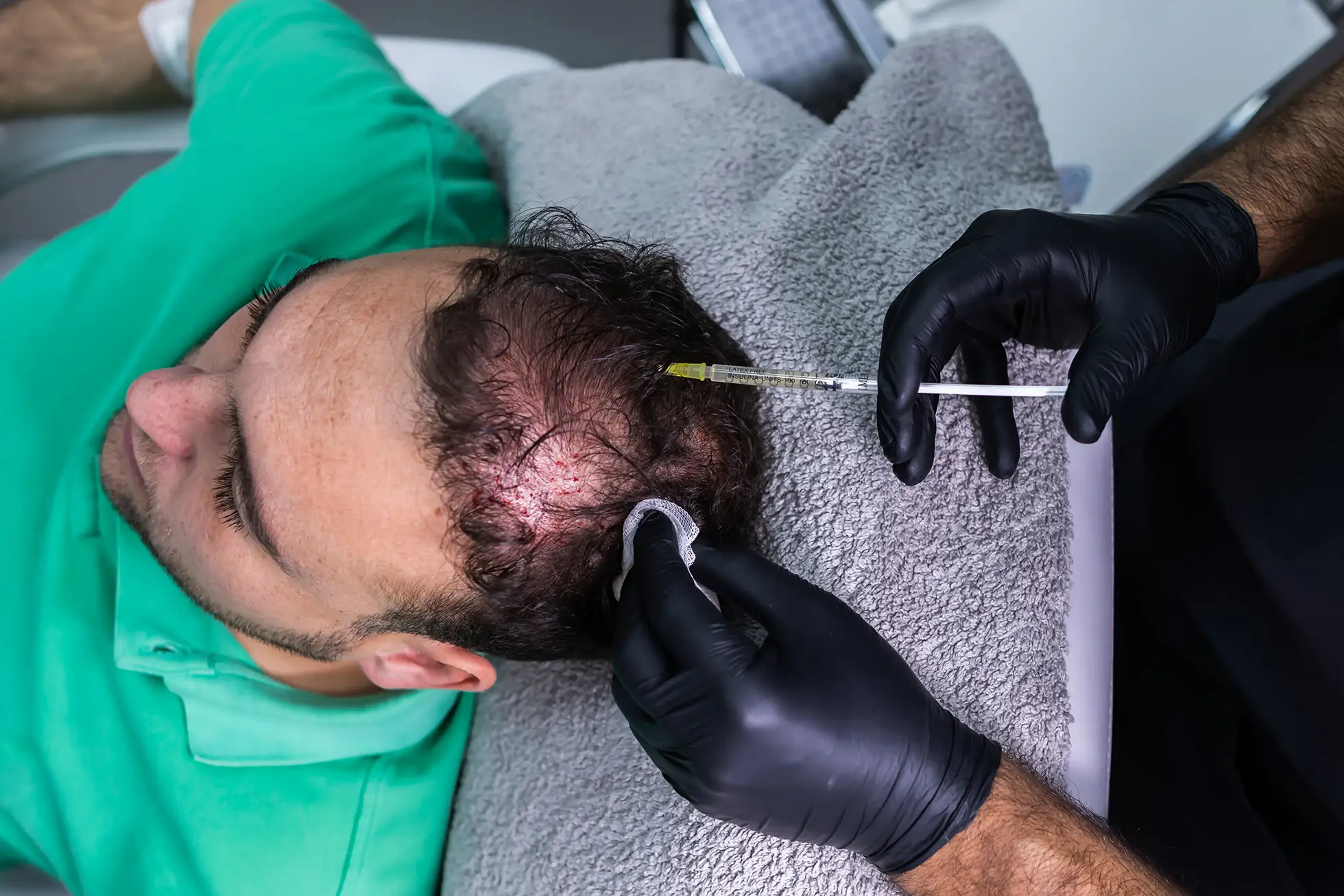 Exosome for hair loss procedure at Dr. Cinik