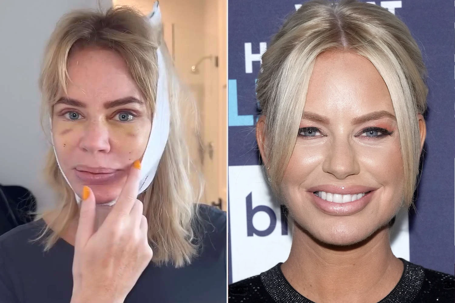 caroline stanbury deep plane facelift