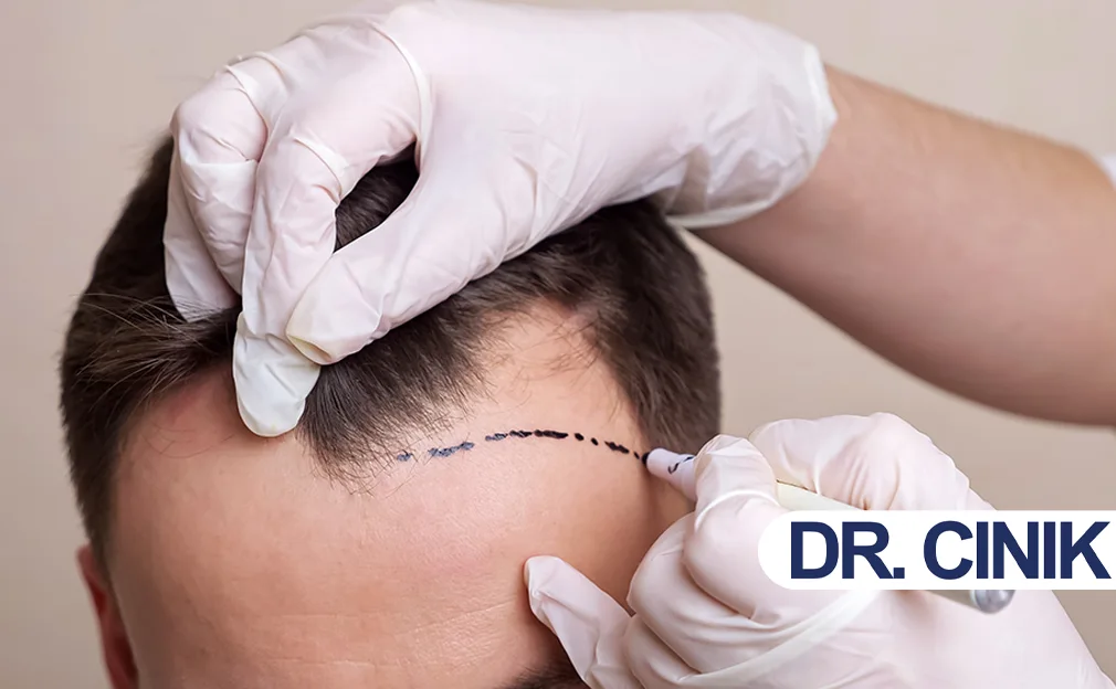 Can You Get a Hair Transplant on a Receding Hairline Only?