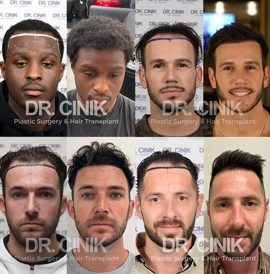 Hairline hair transplants at dr cinik hospital in Turkey