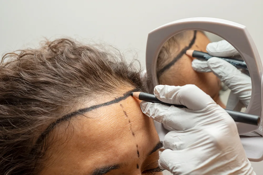 hairline hair transplant without shaving
