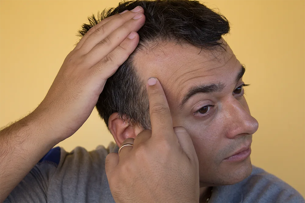 receding hairline solution