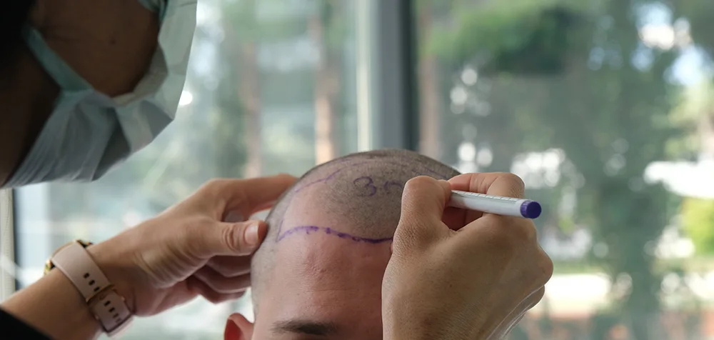 number of grafts needed for a hairline hair transplant