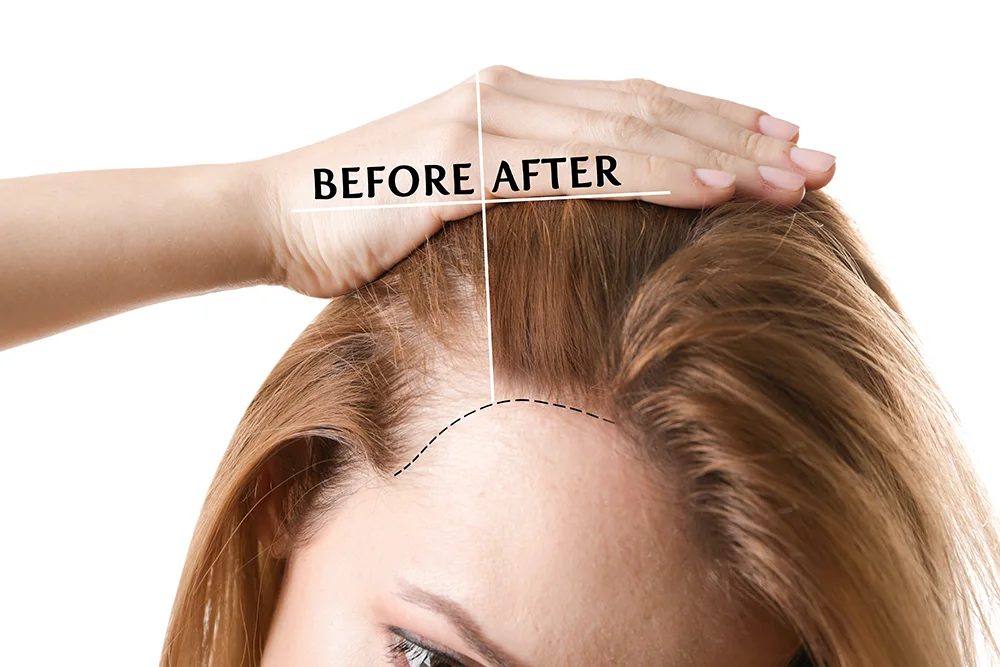 receding hairline for women