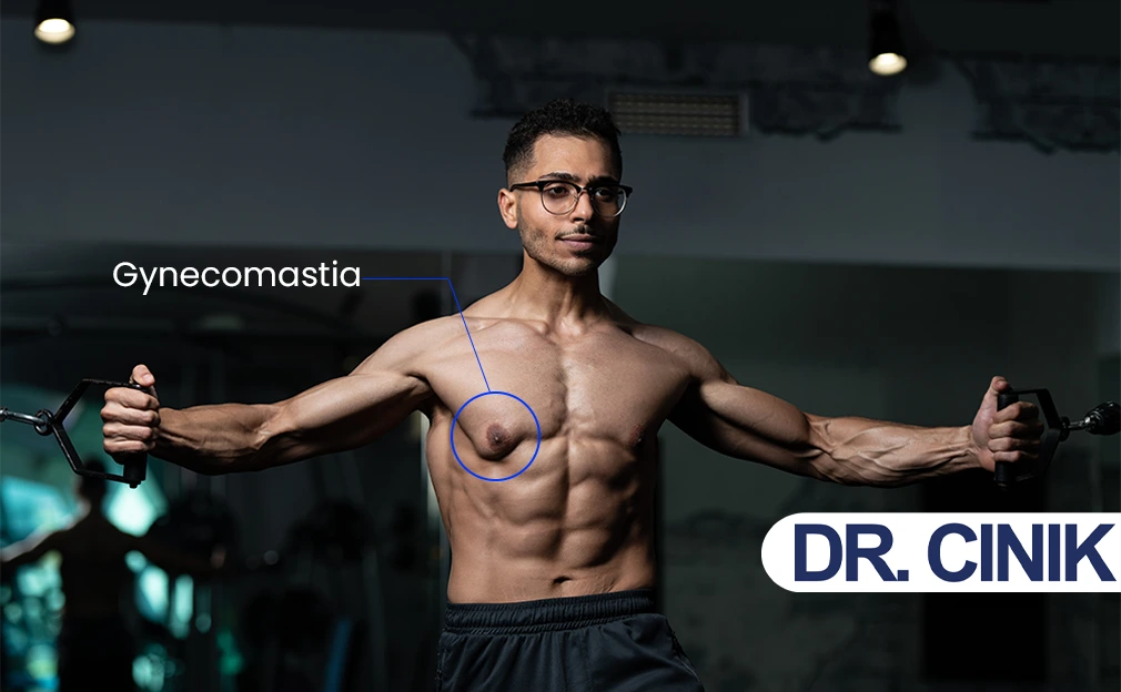 Gynecomastia for Bodybuilders: All You Need to Know!