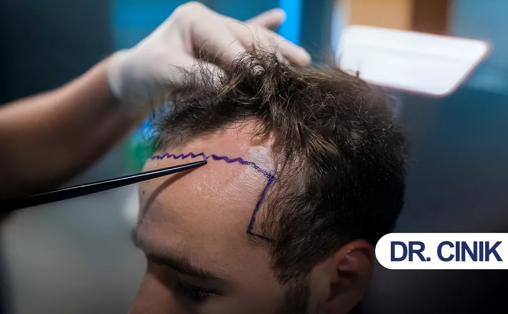 Irregular and Zigzag Hairline Design in Hair Restoration