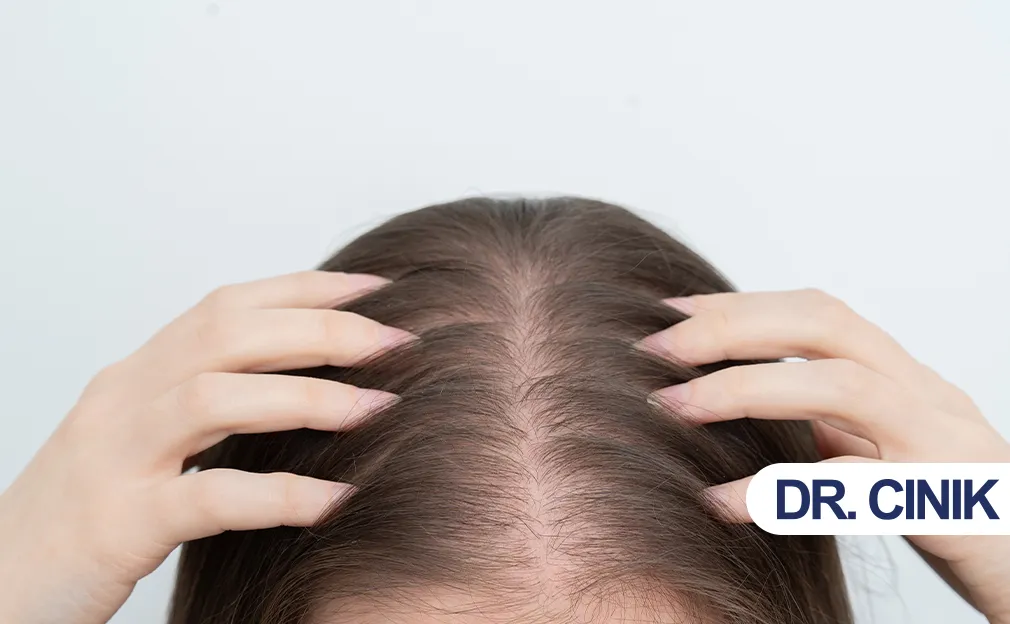 hair loss in women