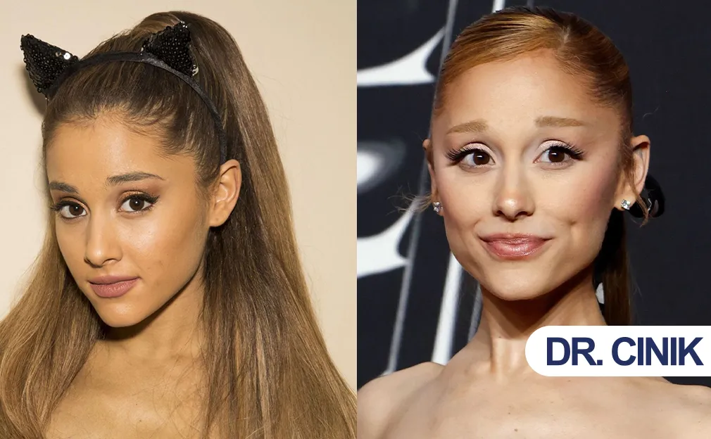 Ariana Grande Plastic Surgery