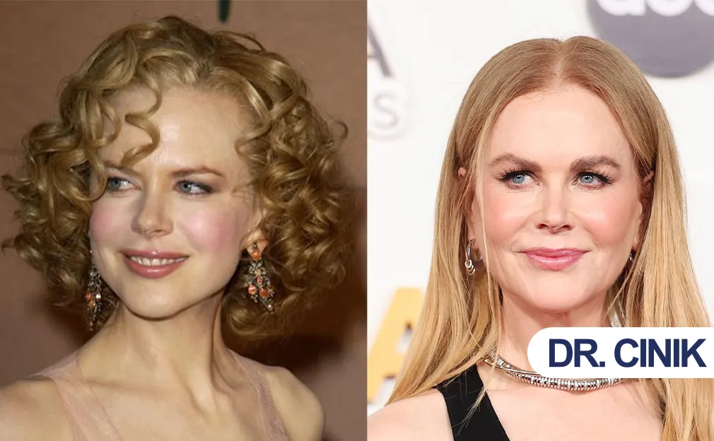 Nicola Kidman Plastic Surgery