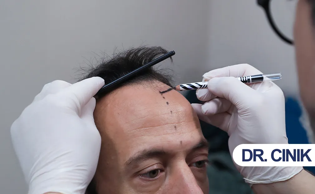 Should I Consider a Hair Transplant?
