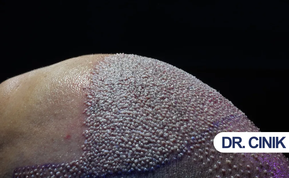 hair transplant