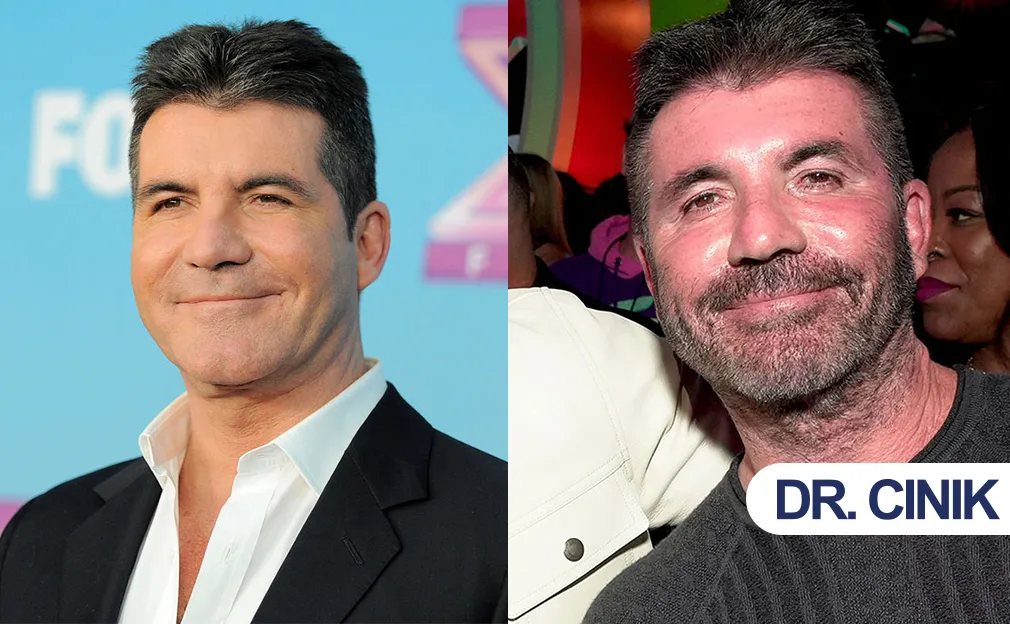 Simon Cowell and Cosmetic Procedures: Public Interest and Perspectives