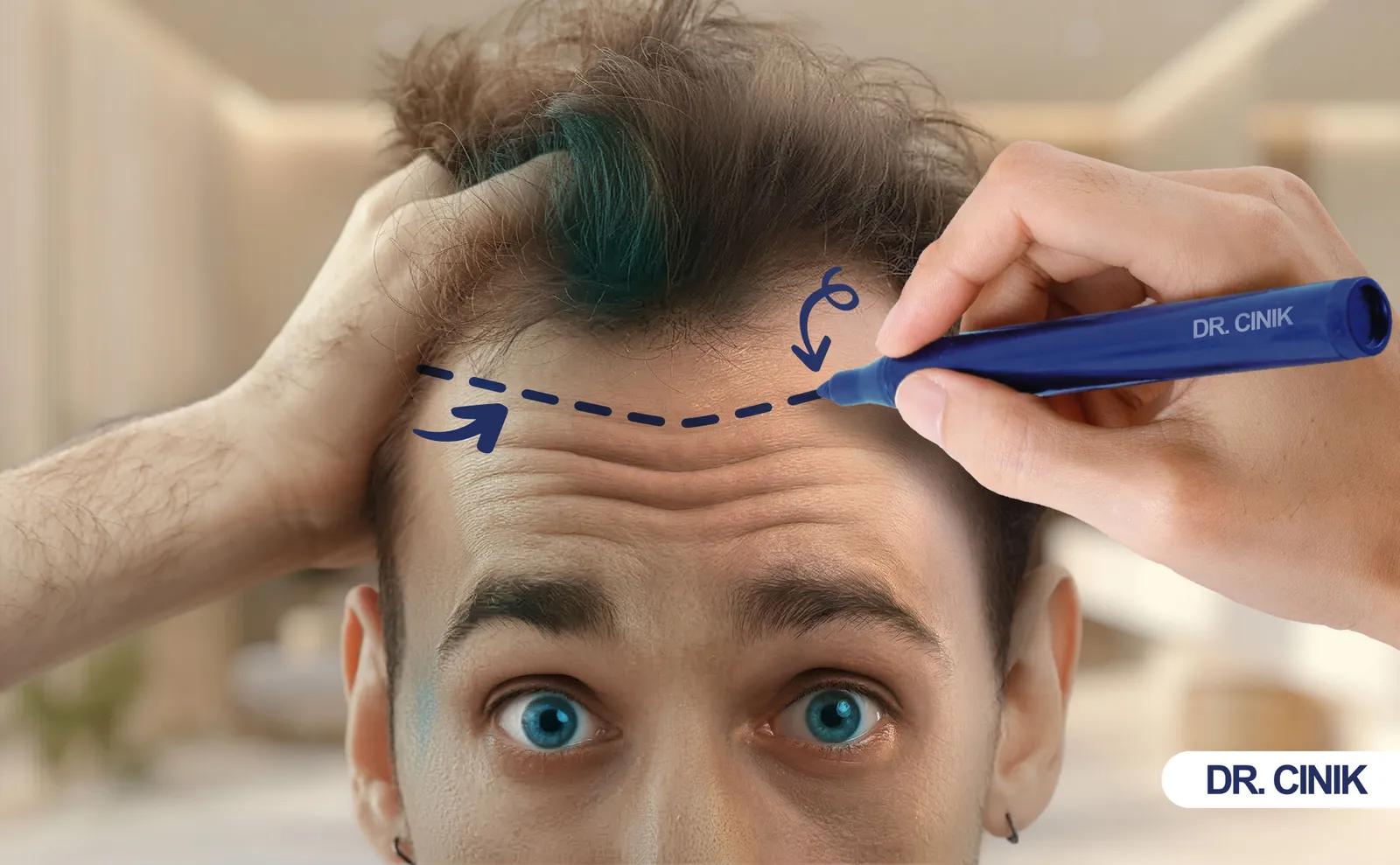 What Is a Widow’s Peak Hair Transplant and Who Needs It?