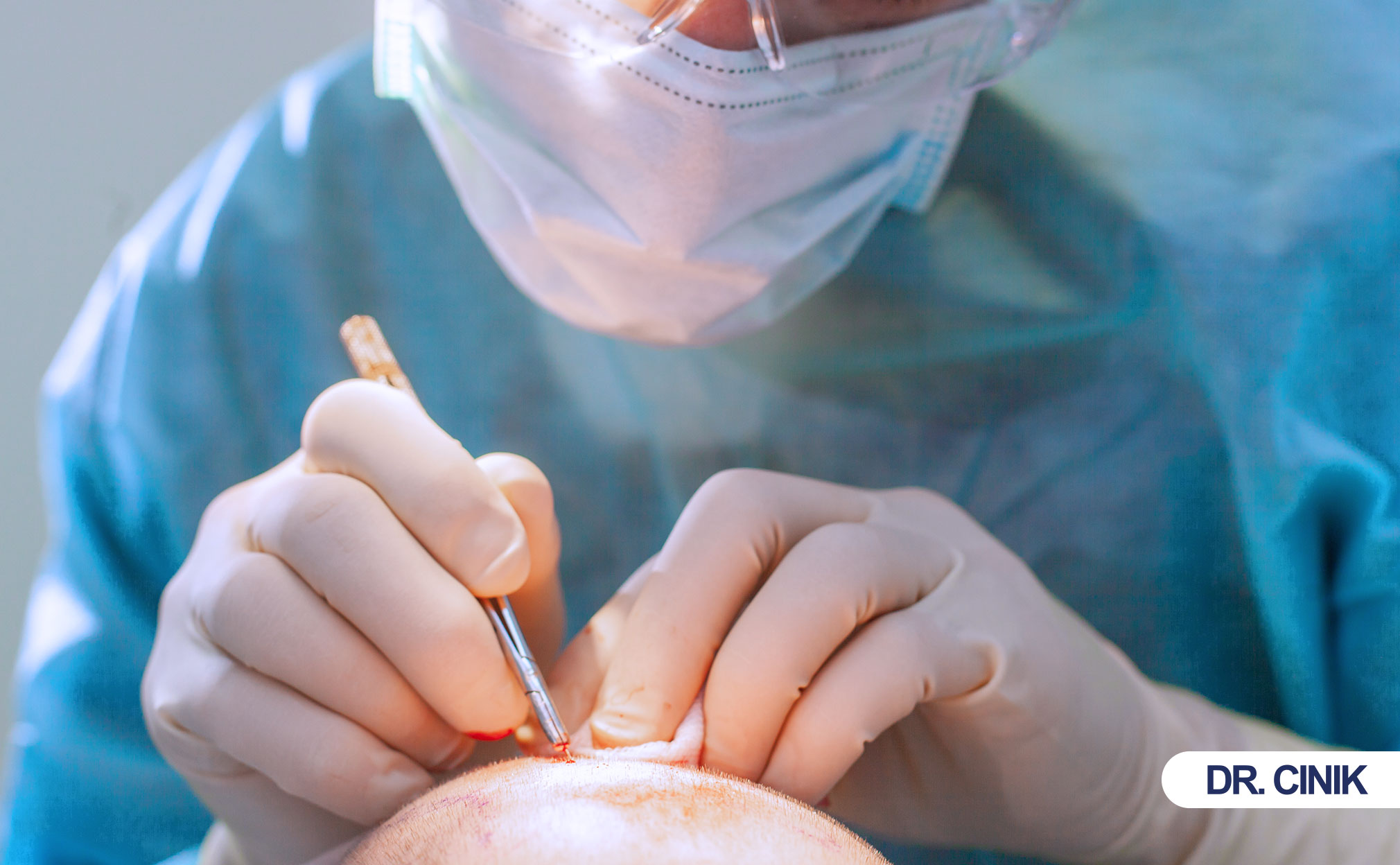 hair transplant