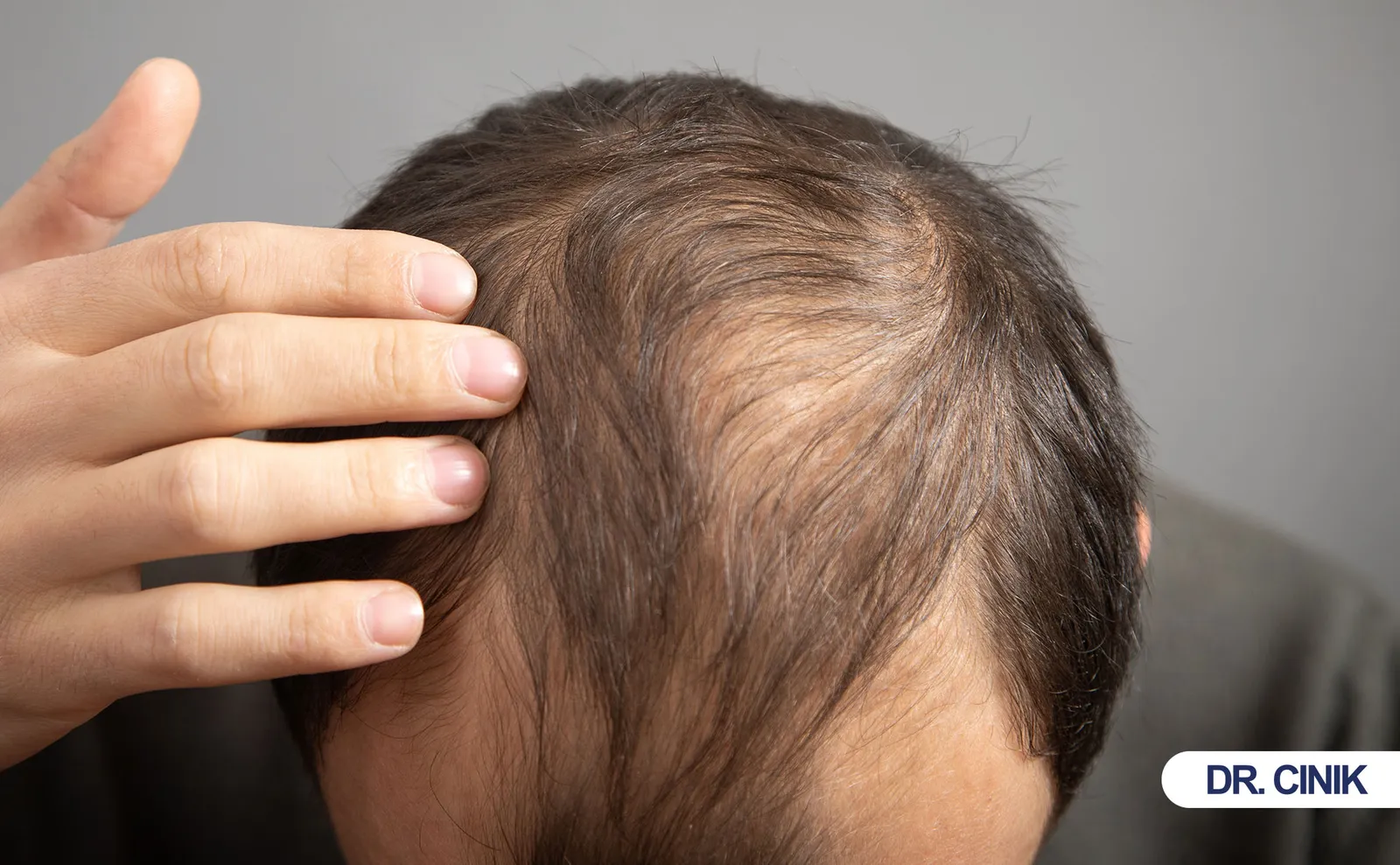 hair transplant