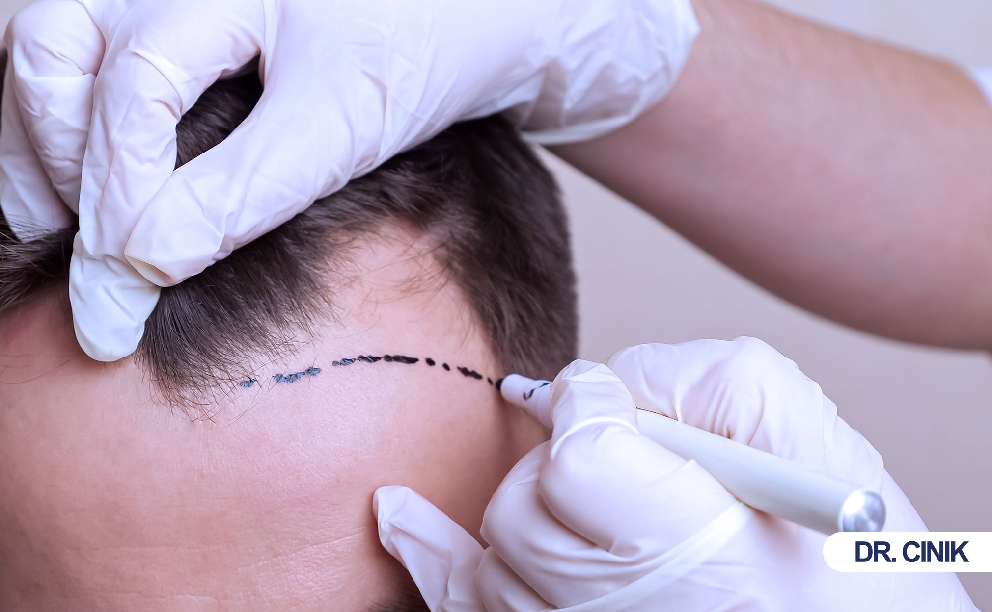 hair transplant