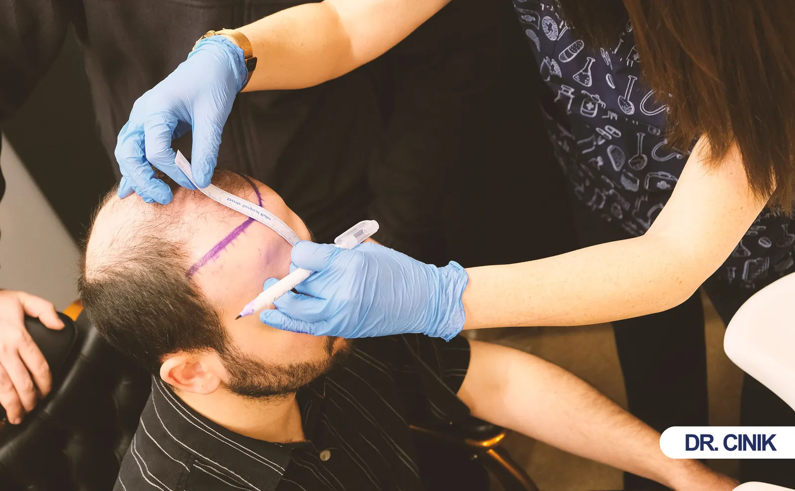 hair transplant