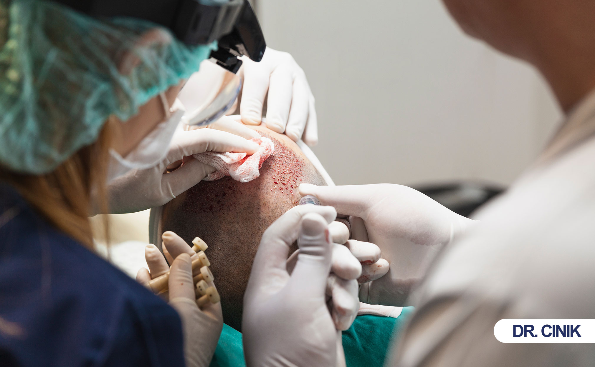 hair transplant