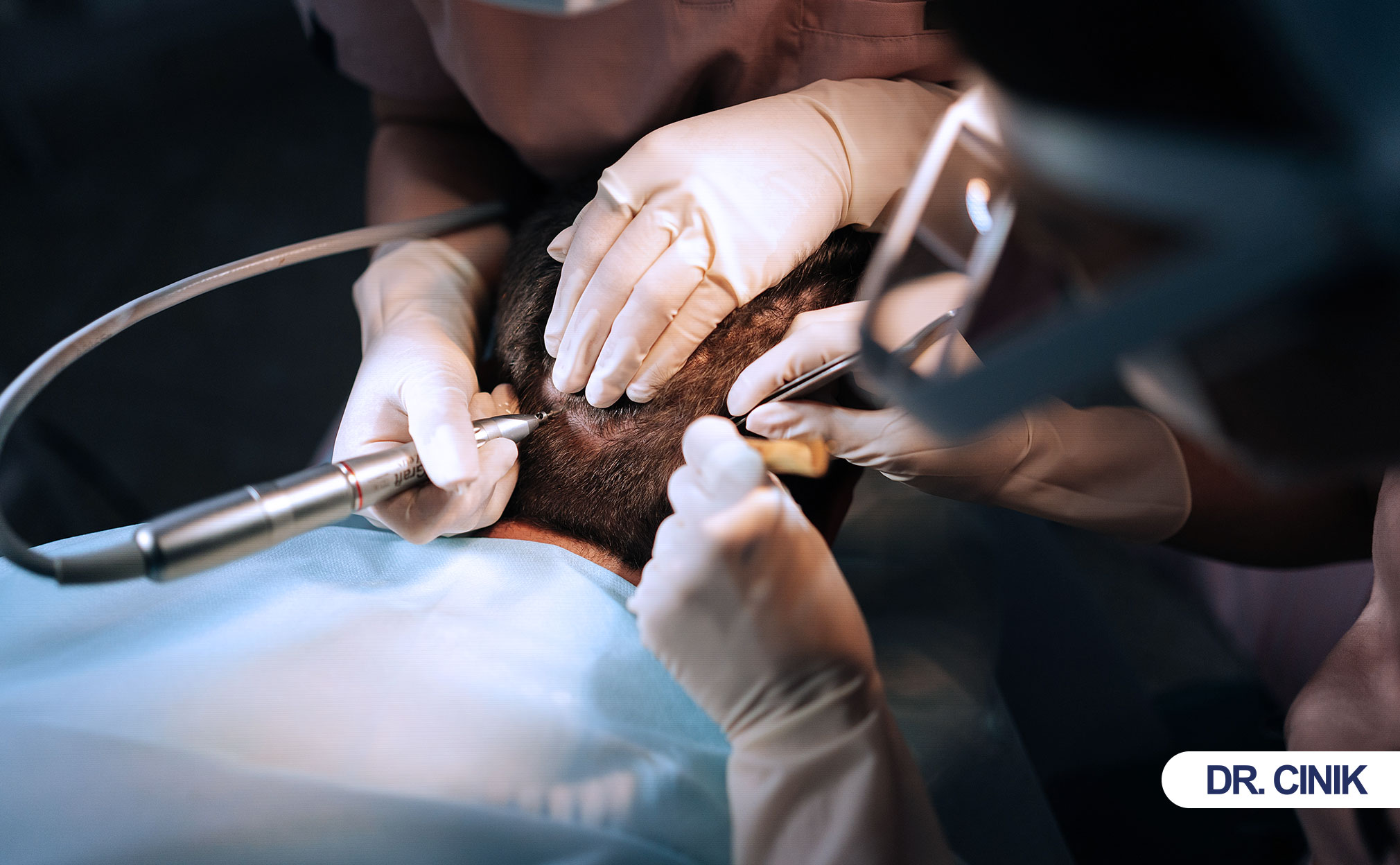 hair transplant