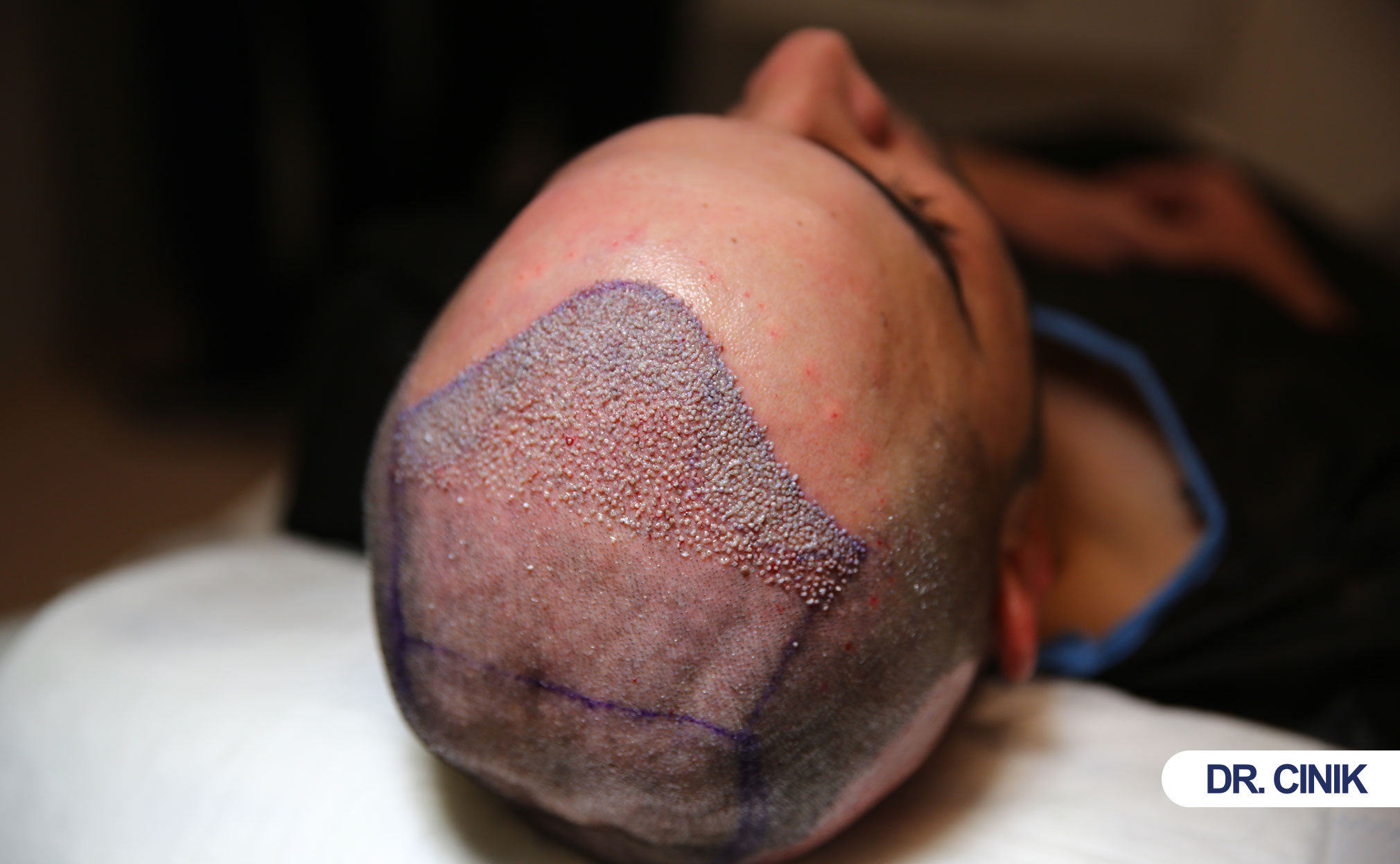 hair transplant