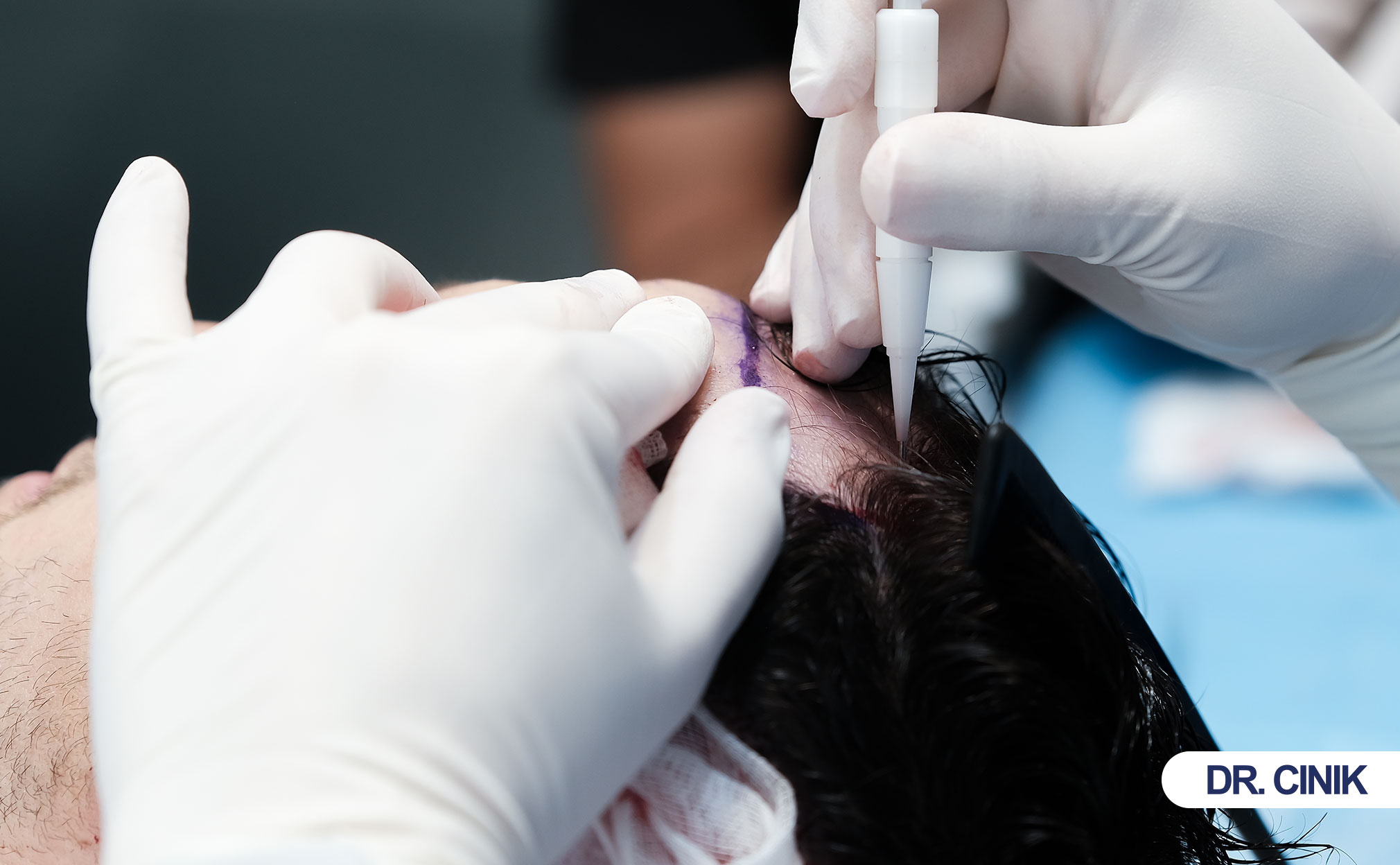 hair transplant