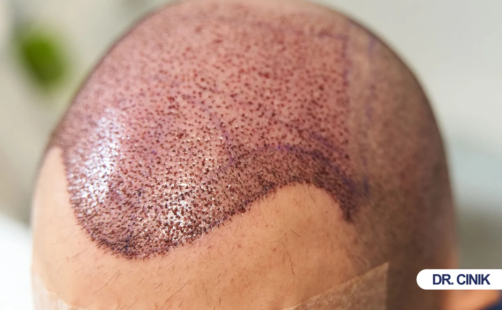 hair transplant