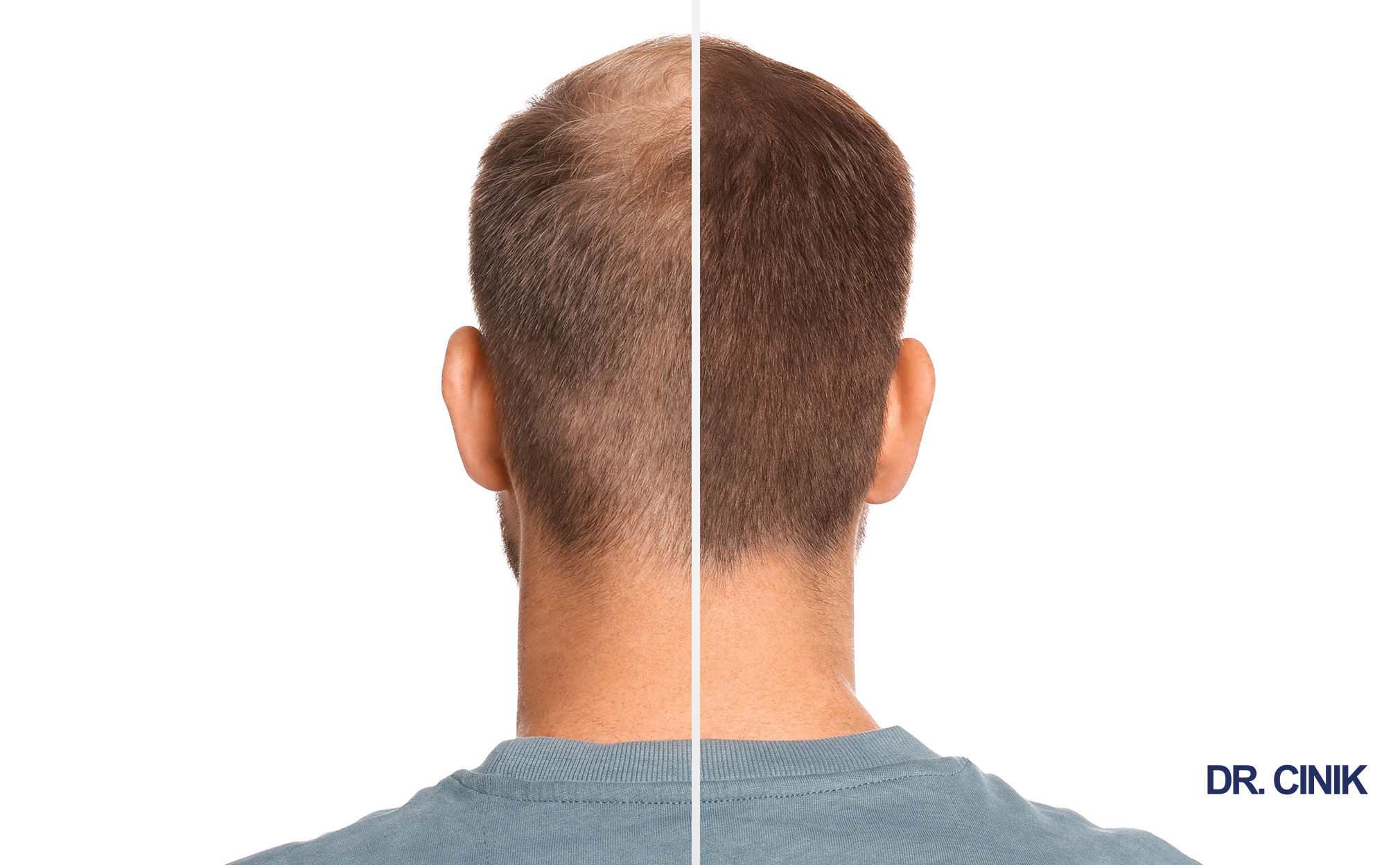 hair transplant