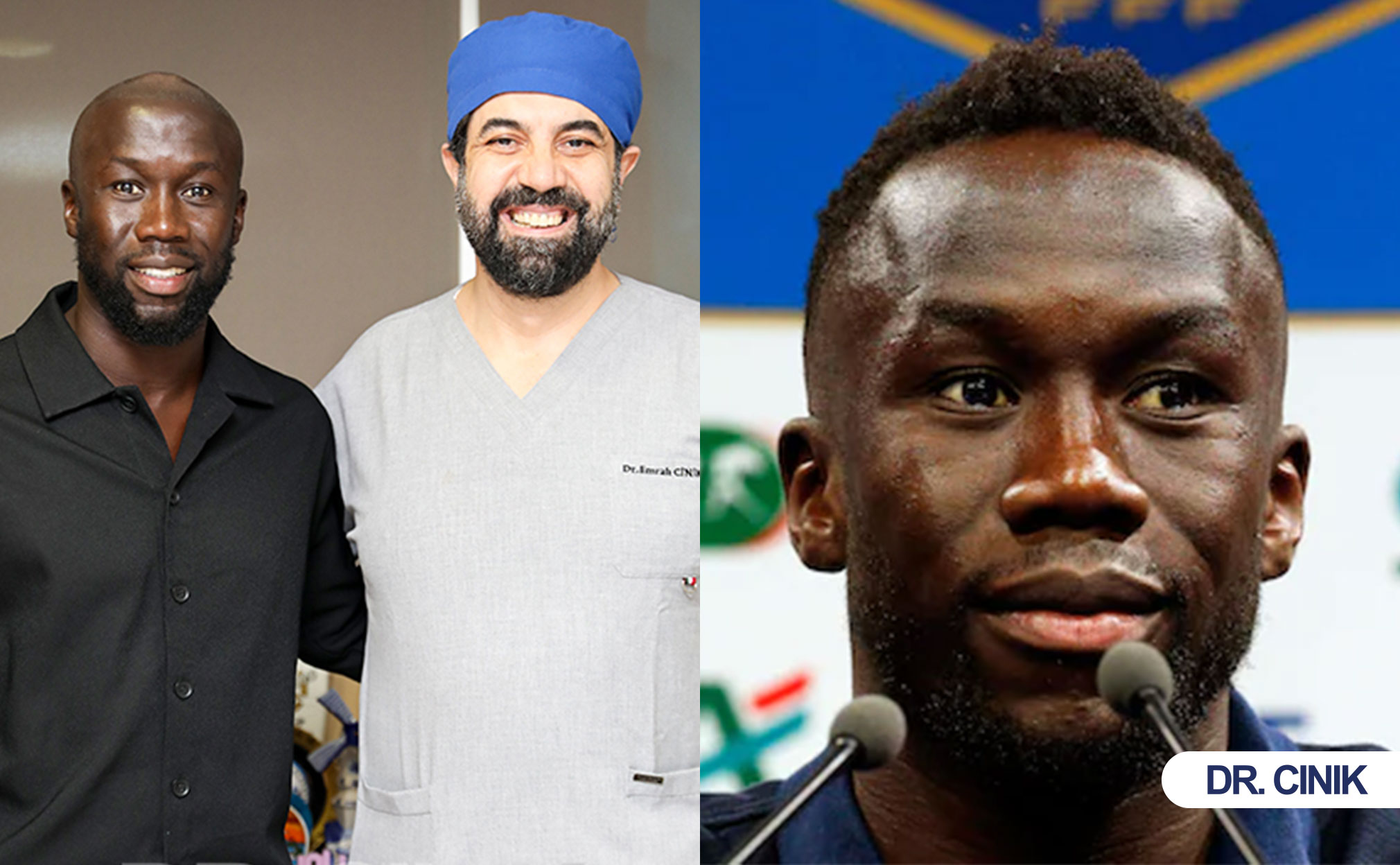 Bacary Sagna Chose Dr. Cinik for His Hair Transplant