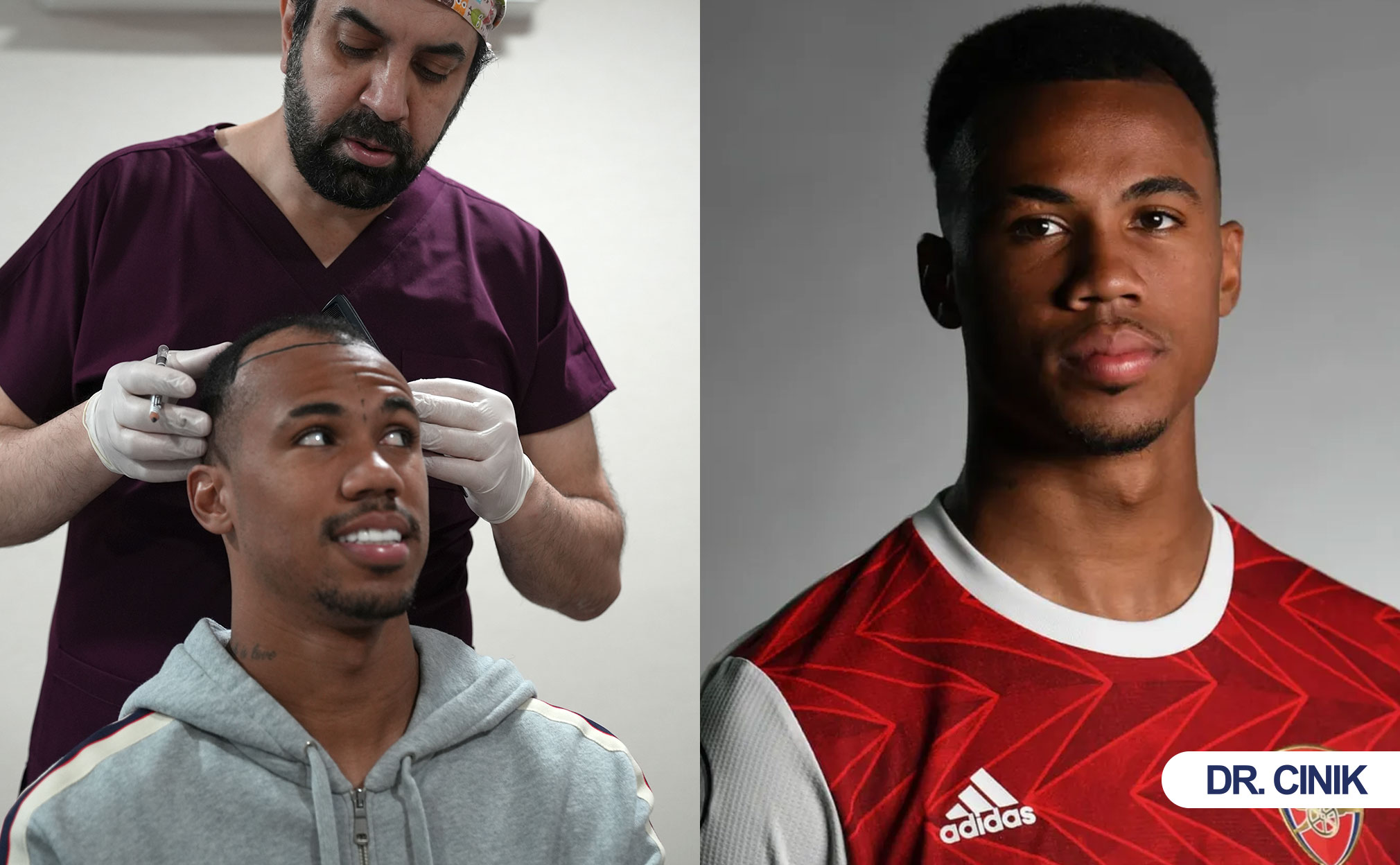hair transplant