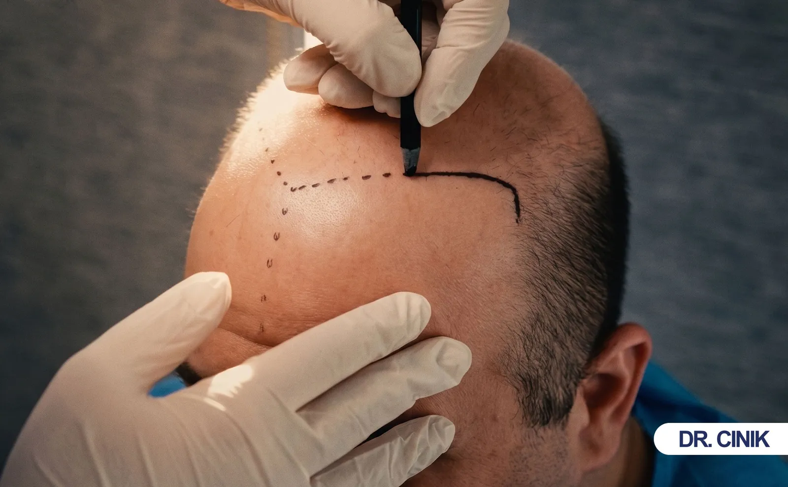 manuel-fue-hair-transplant