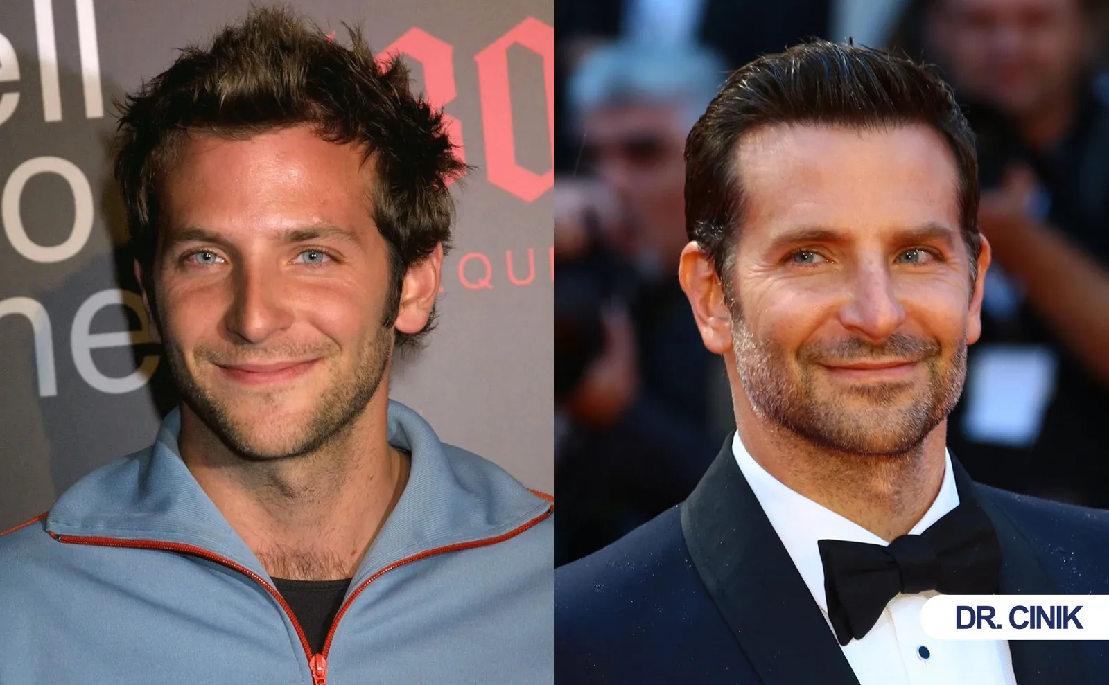 Did Bradley Cooper Really Get Plastic Surgery or Does He Simply Know How to Age Well?