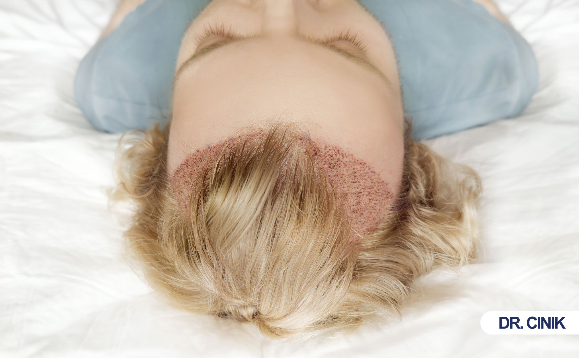 hair transplant