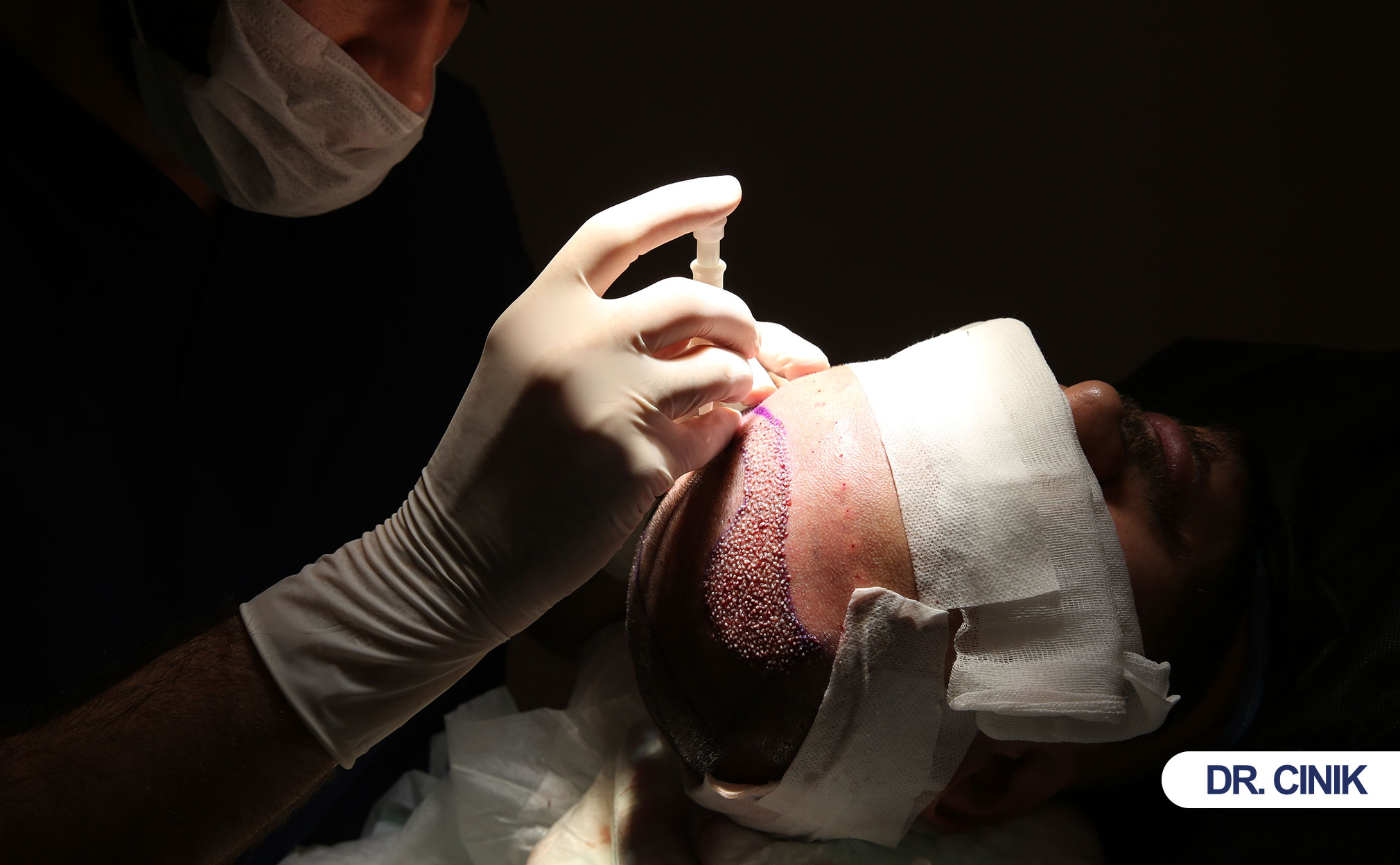 hair transplant